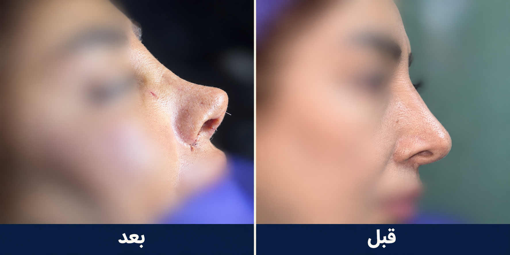 نمونه 1: پیش و پس از جراحی بینی با محوشدن اجزای صورت