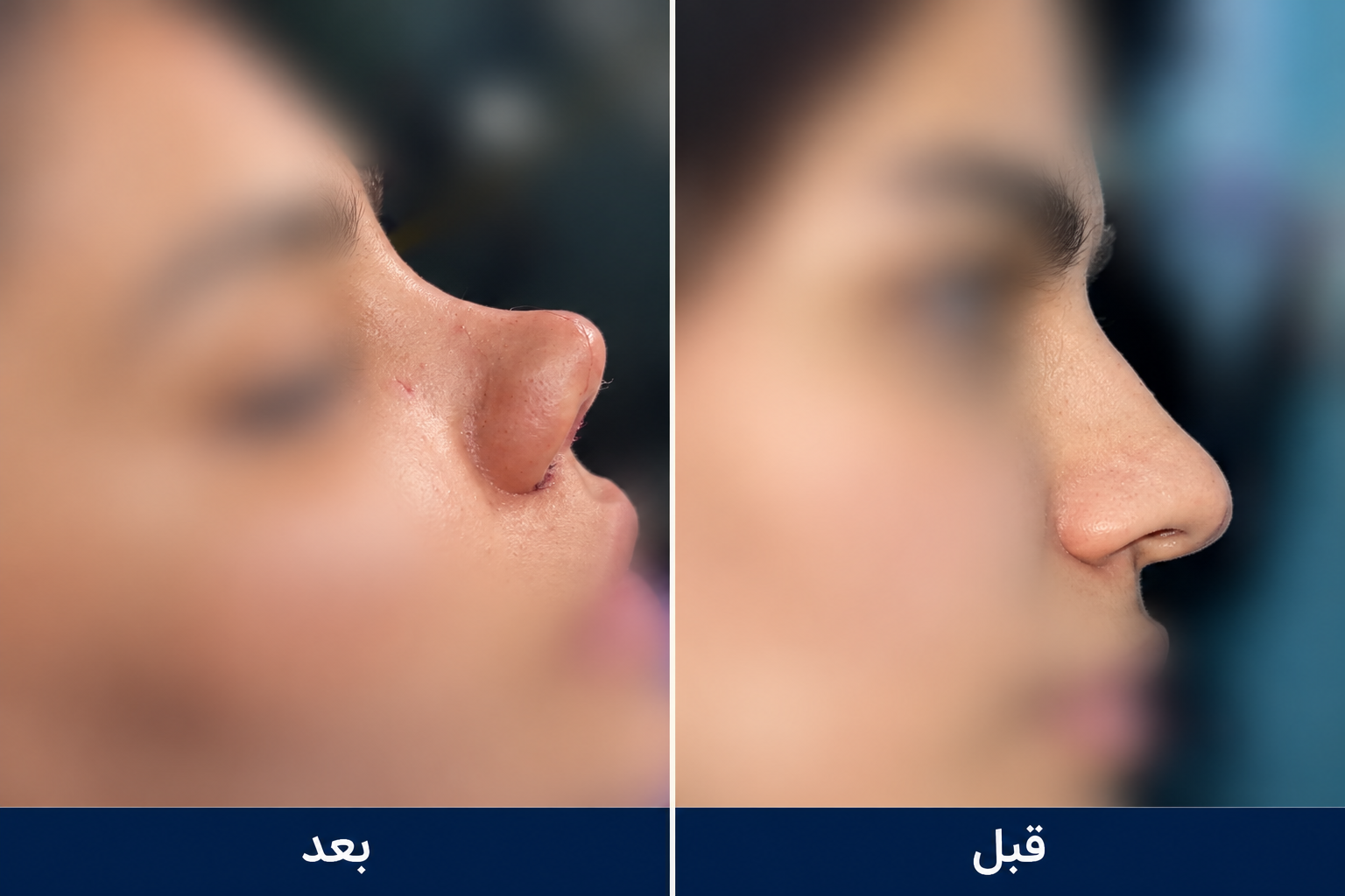 نمونه 2: پیش و پس از جراحی بینی با محوشدن اجزای صورت