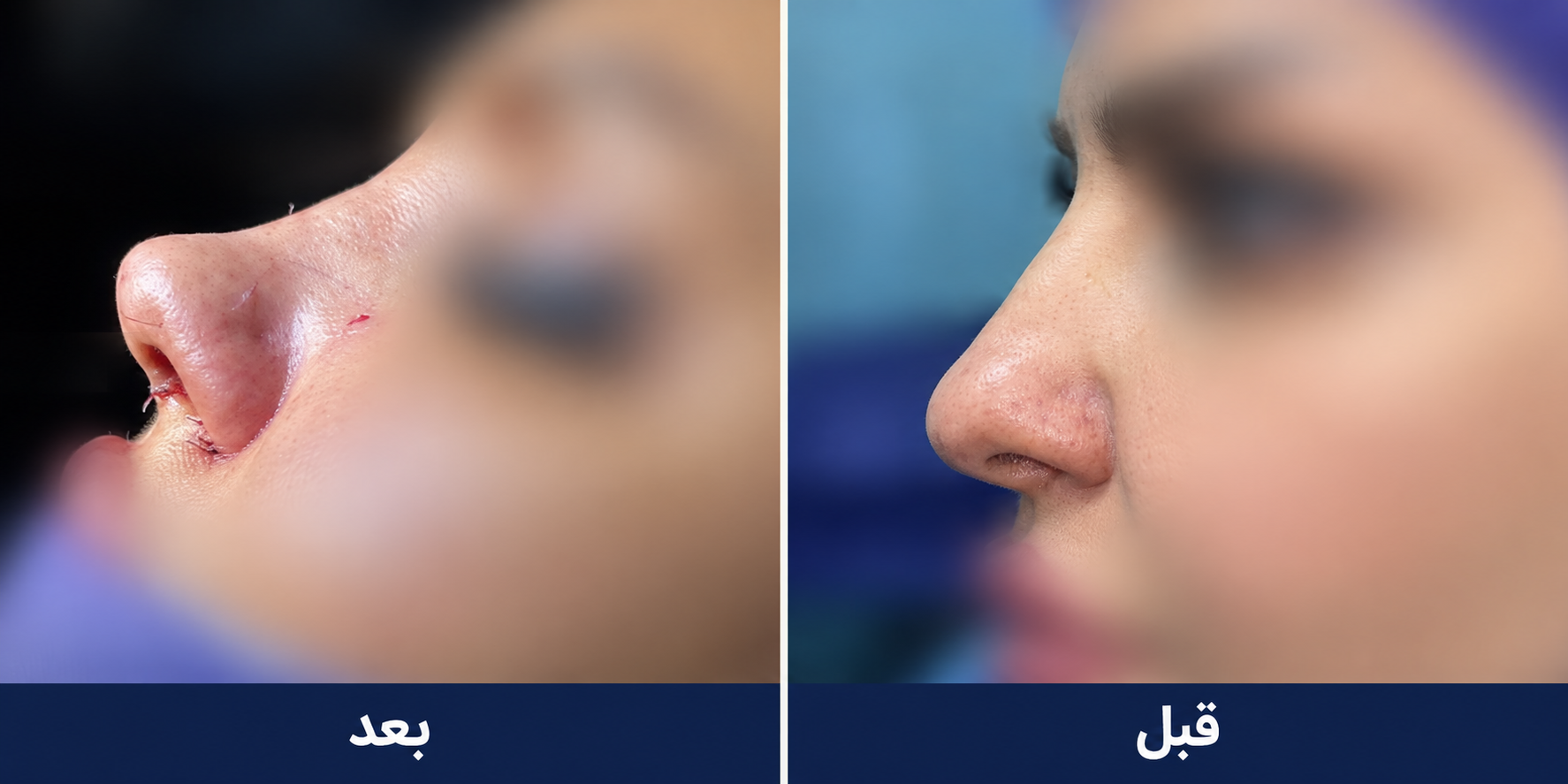 نمونه 3: پیش و پس از جراحی بینی با محوشدن اجزای صورت